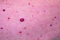 Красные точки на теле: лечение, симптомы, происхождение