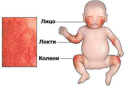 расположение дерматита у младенцев