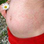 фото атопического дерматита на животе беременной женщины