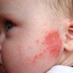 дерматит на щеках у ребенка