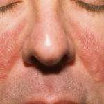 проявление дерматита на щеках