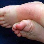 Токсиа аллергенный дерматит на ноге