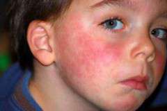 Что такое кожный дерматит и как его лечить
