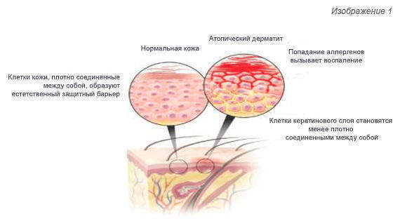Причины возникновения дерматита