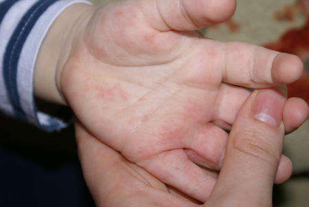 Как вылечить аллергию на руках?