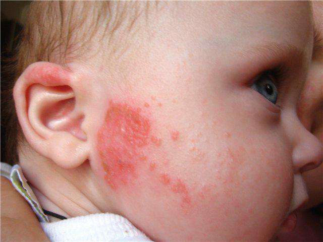 Заболевание аллергическим ринитом в детском возрасте