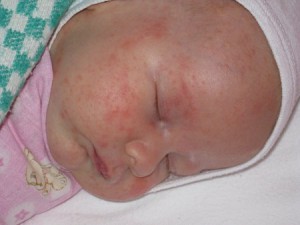 Аллергии у новорожденных