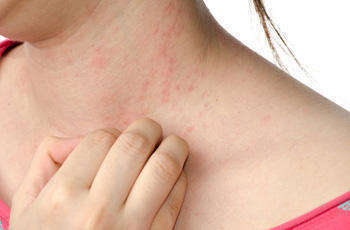 Проявление аллергической сыпи на коже тела