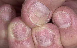 Как избавиться от псориаза на ногтях?