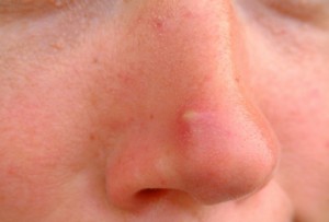 Лечение фурункулеза на лице