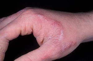 Причины возникновения и степень поражения грибком рук и ногтей