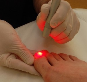 Применение лазера для лечения грибка ногтевой пластины