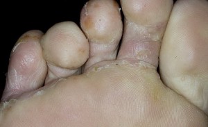 Первые проявления грибка пальцев ног