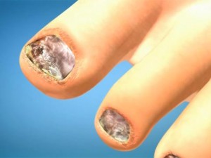 Последствия появления грибка на ногтях