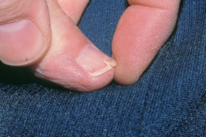 Причины и симптомы грибка на ногтях