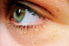 Почему появляются жировики под глазами и как их лечить